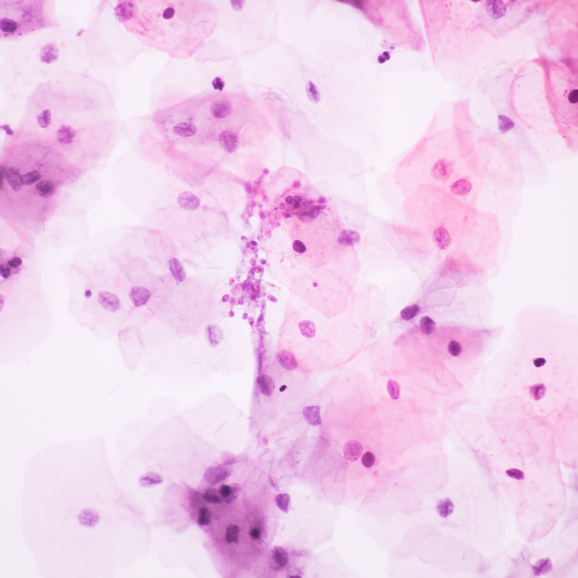 <Stained pink, fungal infection of cells by Candida albicans taken from a cervical smear where oval buds and filaments or hyphae can be seen between hexagonal cells of the host. Credit> AdobeStock_291400737