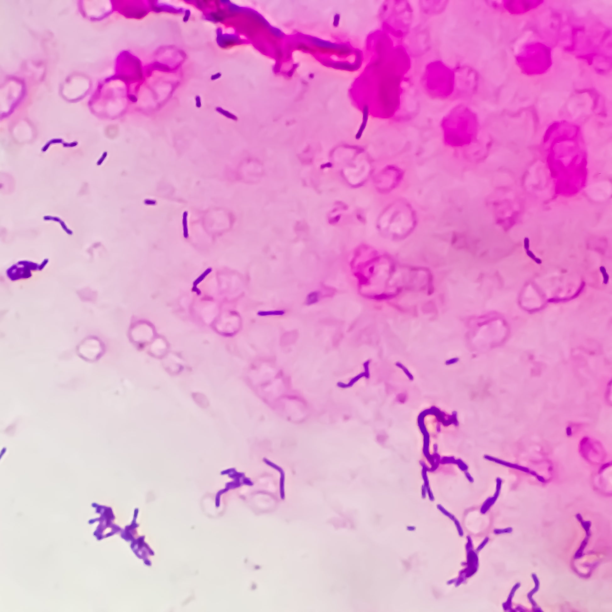 <Microscopic evaluation to show how purple dye can be used to differentiate some gram negative rod like bacteria from the main pink mass with is staphylococcus. Credit> AdobeStock_473970741